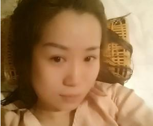 北京衛(wèi)人中醫(yī)醫(yī)院閆國(guó)劍醫(yī)生豐全臉案例：玻尿酸面部填充 - 珍美網(wǎng)
