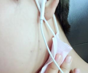 金華商業(yè)整形美容葉彩娣醫(yī)生瘦臉案例：瘦臉 - 珍美網(wǎng)