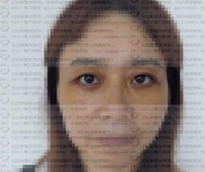 成都溫江達拉斯整形美容診所嚴新醫(yī)生去眼袋案例:外切眼袋