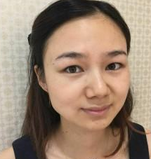 長(zhǎng)沙美研醫(yī)療美容門(mén)診部張彬醫(yī)生瘦臉案例：瘦臉針  - 珍美網(wǎng)