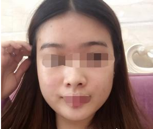 深圳晨曦醫(yī)療美容門(mén)診部朱春艷醫(yī)生瘦臉案例：瘦臉針 - 珍美網(wǎng)
