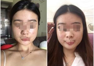 深圳晨曦醫(yī)療美容門(mén)診部朱春艷醫(yī)生瘦臉案例：瘦臉針 - 珍美網(wǎng)