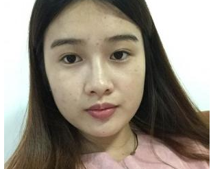 深圳晨曦醫(yī)療美容門(mén)診部朱春艷醫(yī)生瘦臉案例：瘦臉針 - 珍美網(wǎng)