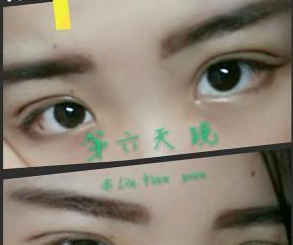 北京葉美人醫(yī)療美容診所余森林醫(yī)生割雙眼皮案例:人都夸我美美了 - 珍美網(wǎng)