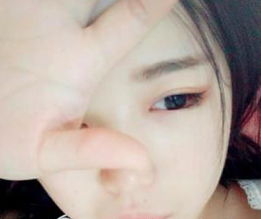 北京葉美人醫(yī)療美容診所余森林醫(yī)生割雙眼皮案例:人都夸我美美了