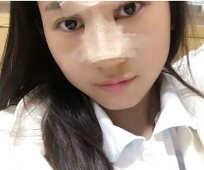 重慶星宸美容醫(yī)院彭紹宗醫(yī)生鼻部綜合整形案例：我的小翹鼻 - 珍美網(wǎng)