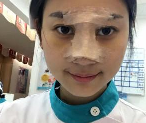 重慶星宸美容醫(yī)院彭紹宗醫(yī)生鼻部綜合整形案例：我的小翹鼻 - 珍美網(wǎng)