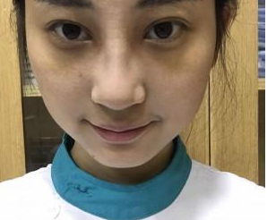 重慶星宸美容醫(yī)院彭紹宗醫(yī)生鼻部綜合整形案例：我的小翹鼻 - 珍美網(wǎng)