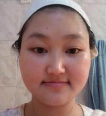 上海美爾雅醫(yī)療美容門診部劉榮升醫(yī)生瘦臉案例：效果好，大臉秒變 - 珍美網(wǎng)