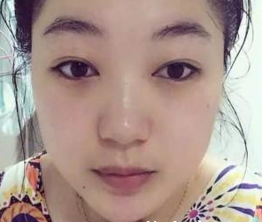 上海美爾雅醫(yī)療美容門診部劉榮升醫(yī)生瘦臉案例：效果好，大臉秒變 - 珍美網(wǎng)