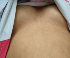 深圳匯仁整形美容門診部陳洪醫(yī)生隆胸案例：自體脂肪填充第一次 - 珍美網(wǎng)