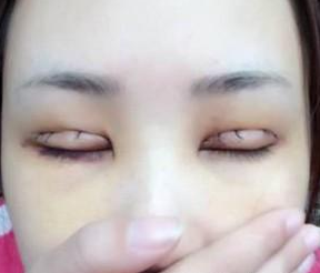 雙眼皮手術(shù) 眼睛更加迷人好看 - 珍美網(wǎng)