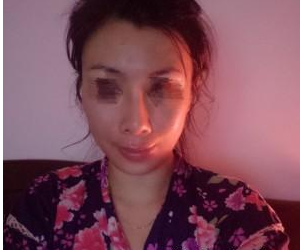 面部填充 美麗離我也不是很遠 - 珍美網(wǎng)