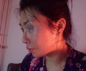 面部填充 美麗離我也不是很遠(yuǎn)