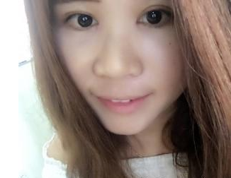 割雙眼皮手術(shù) 讓我更加美麗動人