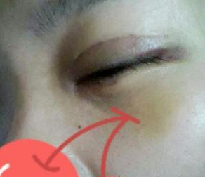 魚尾紋除皺 美麗起來不是大問題 - 珍美網(wǎng)