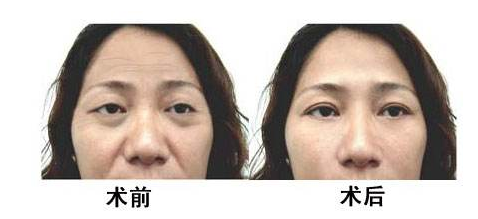 電波拉皮除皺后會(huì)不會(huì)反彈