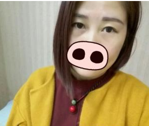 玻尿酸填充多個部位  寶媽也能夠還原當(dāng)初的美麗 - 珍美網(wǎng)
