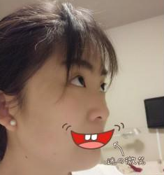 雙眼皮手術(shù)  面部整體看起來(lái)美膩好多啊 - 珍美網(wǎng)