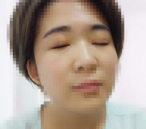 雙眼皮手術(shù)  面部整體看起來美膩好多啊