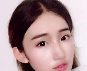 雙眼皮手術(shù) 看著鏡里的自己好看的差點愛上自己 - 珍美網(wǎng)