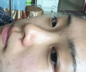 玻尿酸隆鼻  拍照的時(shí)候我才意識(shí)到鼻子有多重要 - 珍美網(wǎng)