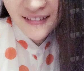玻尿酸豐下巴  變小v臉真的很開(kāi)心 - 珍美網(wǎng)