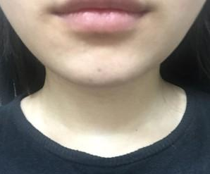 瘦臉針  讓男人目不轉(zhuǎn)睛的氣質(zhì)女