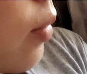 玻尿酸豐下巴  完美臉型從下巴開始 - 珍美網(wǎng)