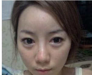脂肪面部填充+PRP  變成正妹指數(shù)爆表 - 珍美網(wǎng)