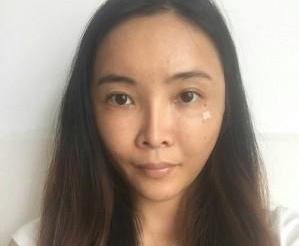 自體脂肪填充  重新找回美麗動(dòng)人的我 - 珍美網(wǎng)