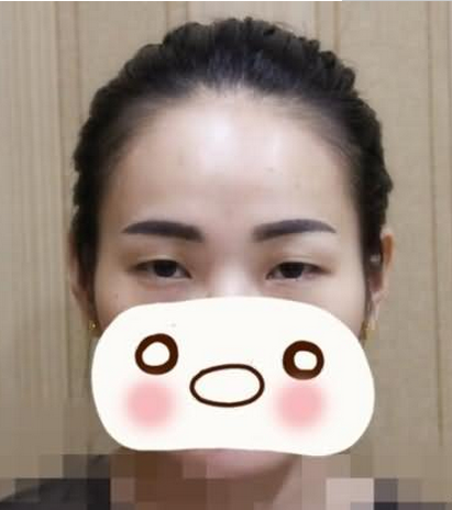 割雙眼皮手術(shù)  讓我重新感受到我的不一樣的美麗 - 珍美網(wǎng)