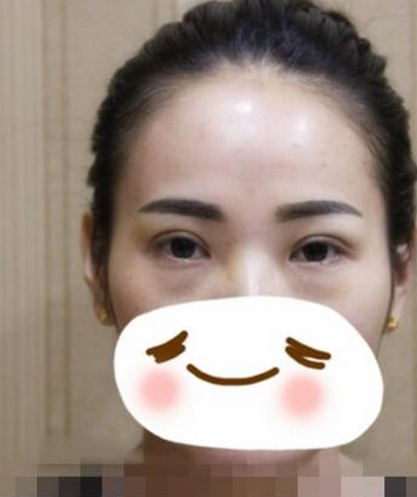 割雙眼皮手術(shù)  讓我重新感受到我的不一樣的美麗 - 珍美網(wǎng)