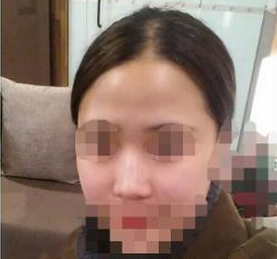 玻尿酸填充鼻梁  精致立體的五官讓我美的不要不要的 - 珍美網(wǎng)