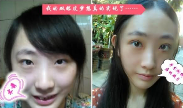 雙眼皮手術(shù) 小眼變大眼真的美出一個(gè)境界 - 珍美網(wǎng)