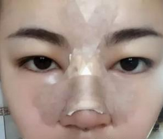 假體隆鼻  讓我更加有氣質了 - 珍美網(wǎng)