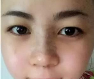 假體隆鼻  讓我更加有氣質了 - 珍美網(wǎng)