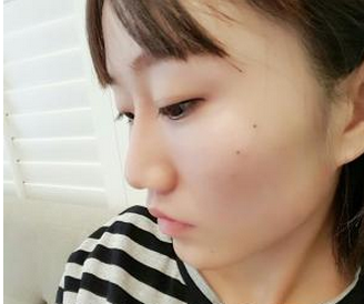 玻尿酸面部填充 快速告別蒼老的現(xiàn)象實(shí)現(xiàn)活力美的自己 - 珍美網(wǎng)
