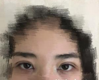 雙眼皮手術  眼睛變亮變大更讓人喜愛 - 珍美網(wǎng)