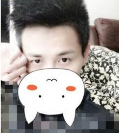 鄭州麗天醫(yī)療美容門診部陳紅燕醫(yī)生割雙眼皮案例：割雙眼皮+開眼 - 珍美網(wǎng)
