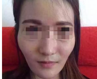 自體脂肪面部填充 煥然一新 - 珍美網(wǎng)