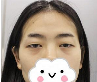 宜昌市伍家崗區(qū)中愛美容門診部李登進(jìn)醫(yī)生割雙眼皮案例：雙眼皮手 - 珍美網(wǎng)