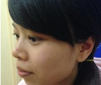 玻尿酸隆下巴  臉部變得柔和讓我更加美麗 - 珍美網(wǎng)