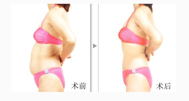 吸脂減肥術(shù)有沒有危害?