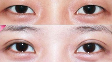 埋線雙眼皮恢復期是多久?