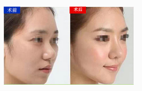 自體脂肪豐蘋(píng)果肌恢復(fù)需要多長(zhǎng)時(shí)間 - 珍美網(wǎng)