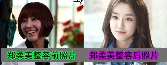 鄭柔美整容了嗎？ 面容突變判若兩人嚇壞網(wǎng)友 - 珍美網(wǎng)
