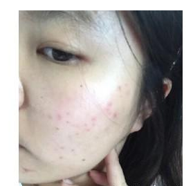 激光祛痘 讓我青春活力每一天 - 珍美網