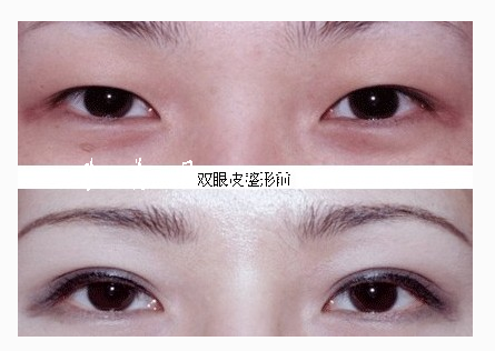 什么時(shí)間割雙眼皮比較好呢