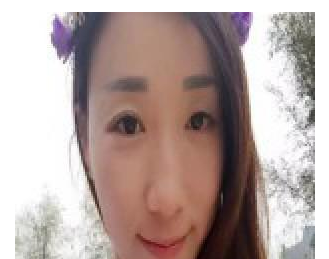 豐全臉手術(shù)  讓我膠原蛋白滿滿光彩照人 - 珍美網(wǎng)